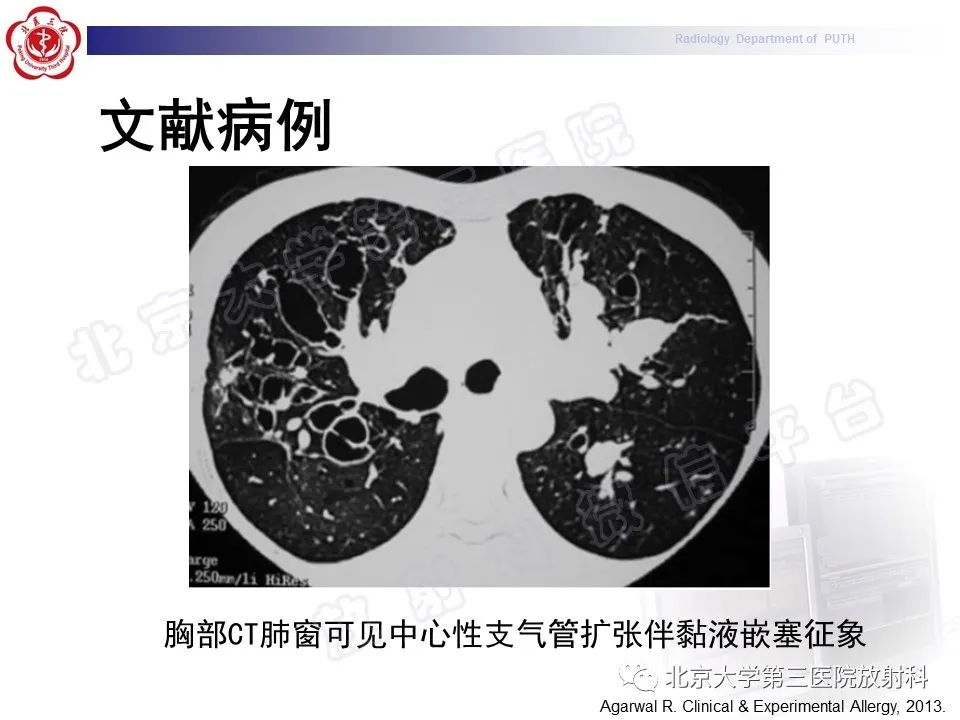 影像PPT - 【PPT】变态反应性支气管肺曲霉菌病-29