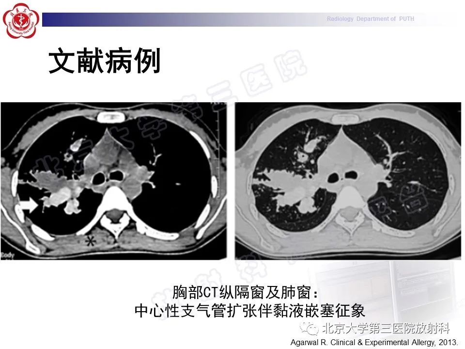 影像PPT - 【PPT】变态反应性支气管肺曲霉菌病-30