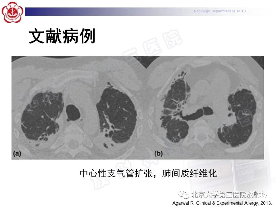 影像PPT - 【PPT】变态反应性支气管肺曲霉菌病-31