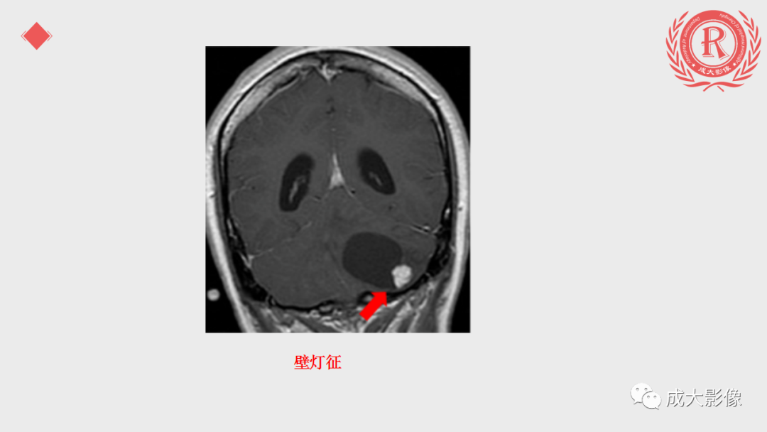 影像PPT - 【PPT】血管母细胞瘤的影像诊断-6