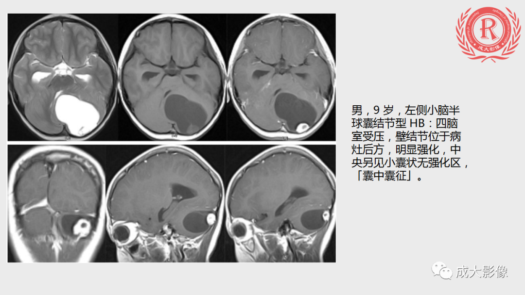 影像PPT - 【PPT】血管母细胞瘤的影像诊断-7