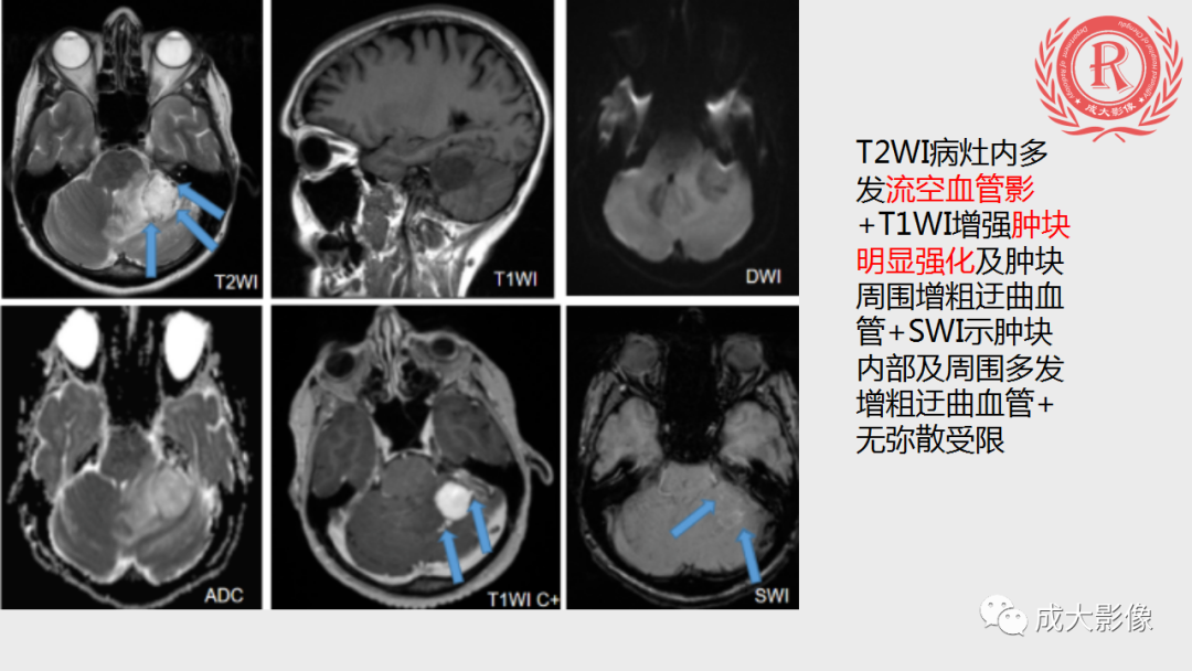 影像PPT - 【PPT】血管母细胞瘤的影像诊断-11