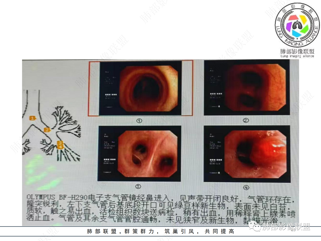 影像PPT - 【病例】支气管腔内结节灶,你能想到哪些病变?-23 影像PPT - 【病例】支气管腔内结节灶,你能想到哪些病变?-23
