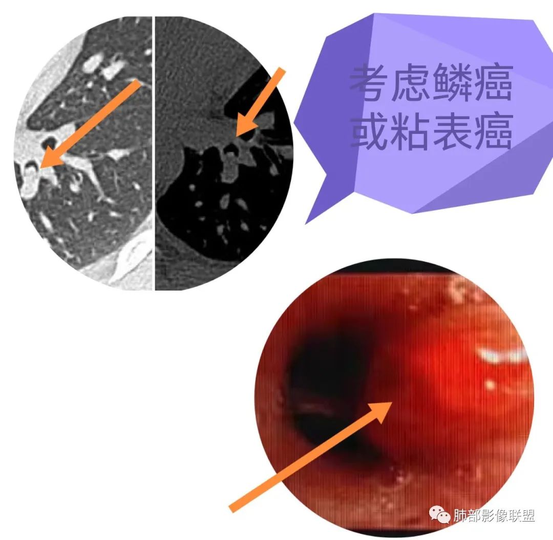 影像PPT - 【病例】支气管腔内结节灶,你能想到哪些病变?-27 影像PPT - 【病例】支气管腔内结节灶,你能想到哪些病变?-27