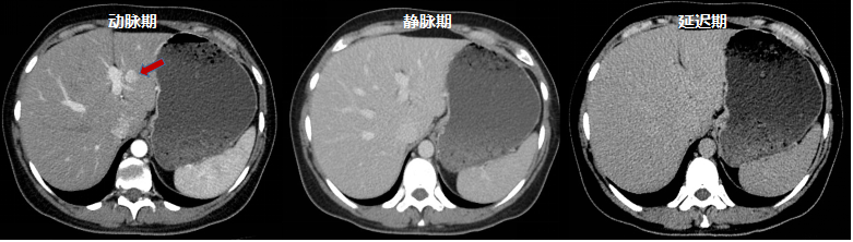 影像PPT - 【病例】结节性硬化症典型病例1例-7 影像PPT - 【病例】结节性硬化症典型病例1例-7