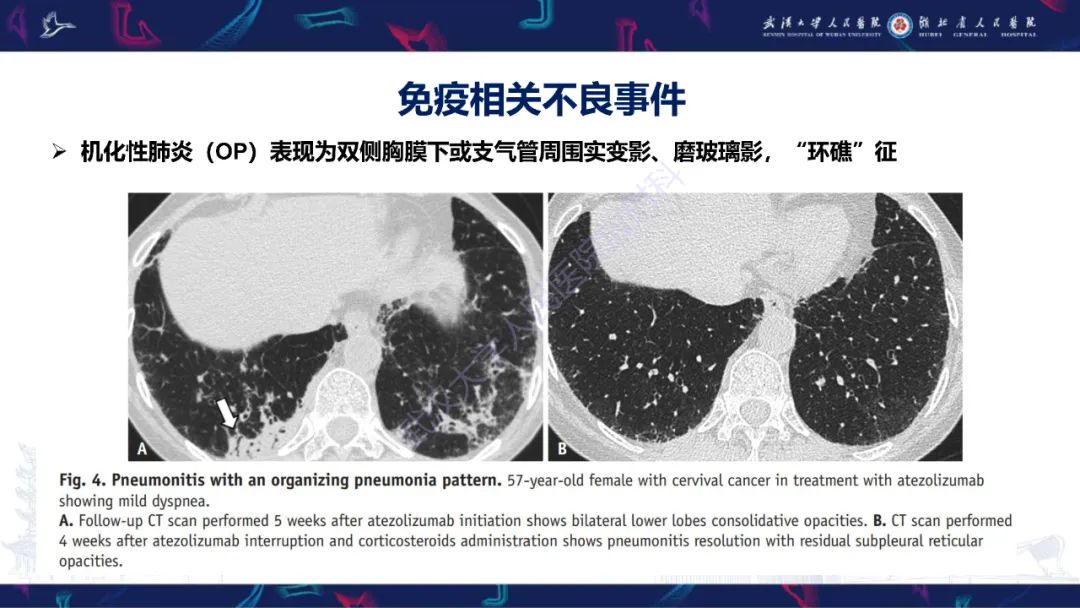 影像PPT - 【PPT】肿瘤免疫治疗疗效及不良事件影像评估-10
