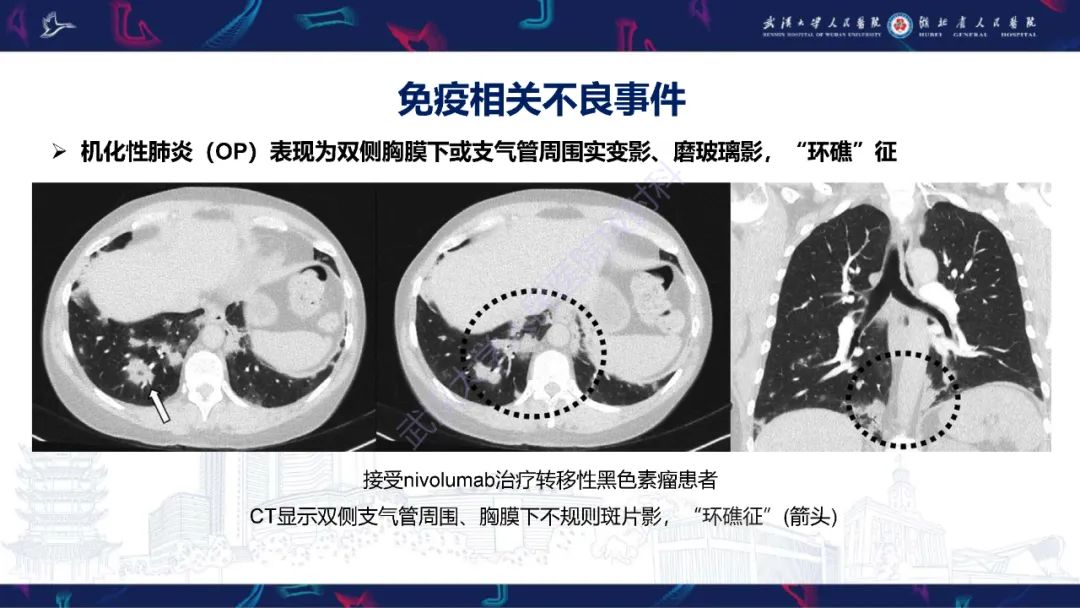 影像PPT - 【PPT】肿瘤免疫治疗疗效及不良事件影像评估-11