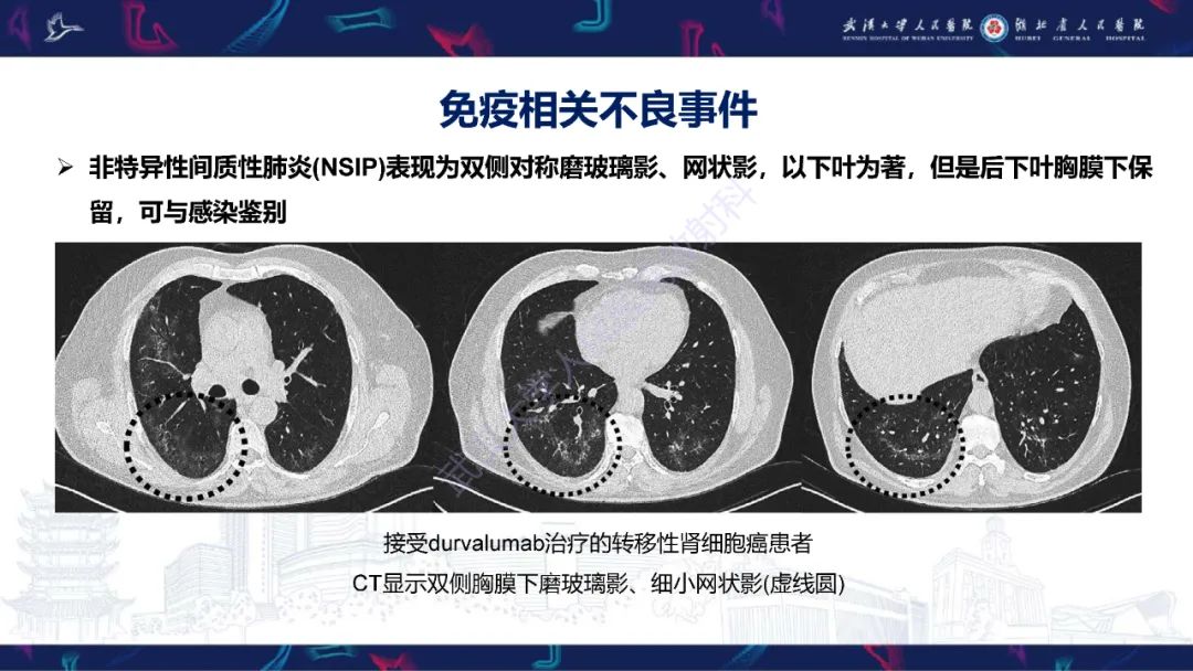影像PPT - 【PPT】肿瘤免疫治疗疗效及不良事件影像评估-12