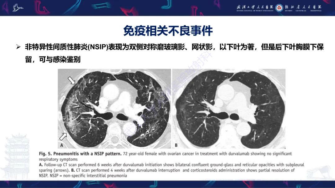 影像PPT - 【PPT】肿瘤免疫治疗疗效及不良事件影像评估-13