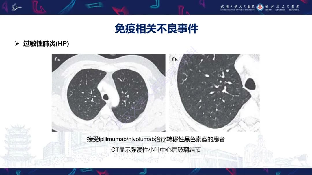 影像PPT - 【PPT】肿瘤免疫治疗疗效及不良事件影像评估-14
