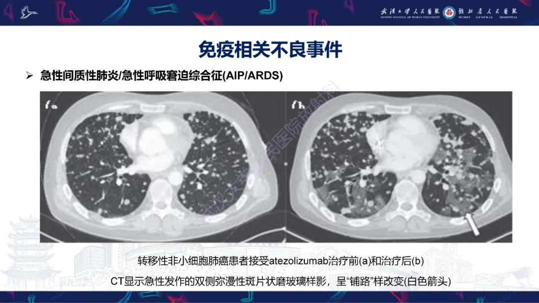影像PPT - 【PPT】肿瘤免疫治疗疗效及不良事件影像评估-15