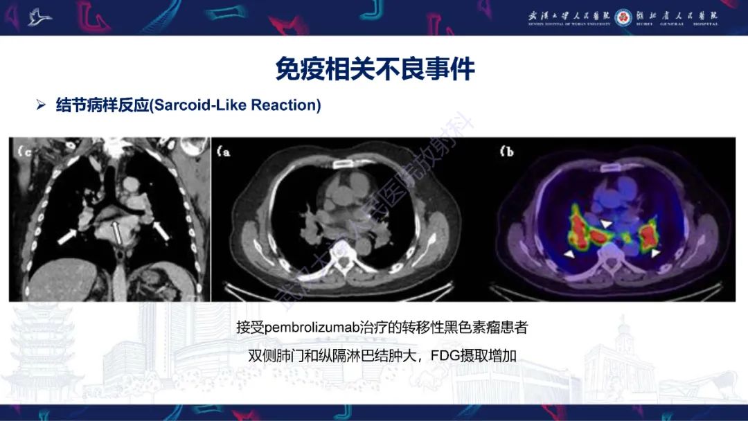 影像PPT - 【PPT】肿瘤免疫治疗疗效及不良事件影像评估-16