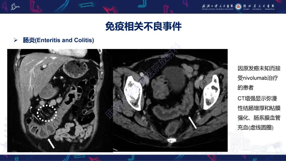 影像PPT - 【PPT】肿瘤免疫治疗疗效及不良事件影像评估-17