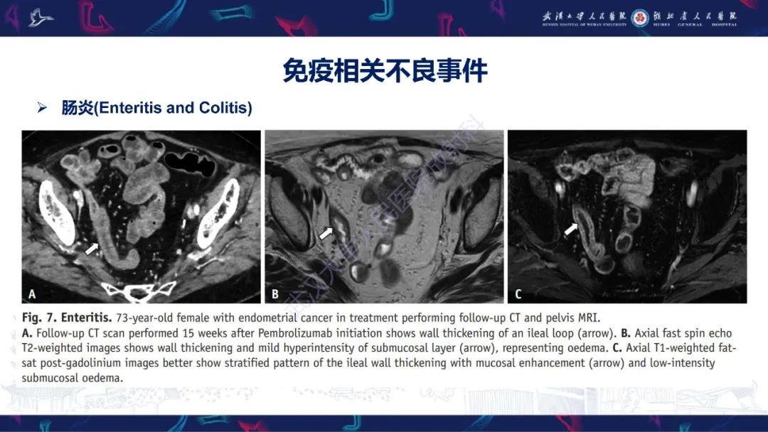 影像PPT - 【PPT】肿瘤免疫治疗疗效及不良事件影像评估-18