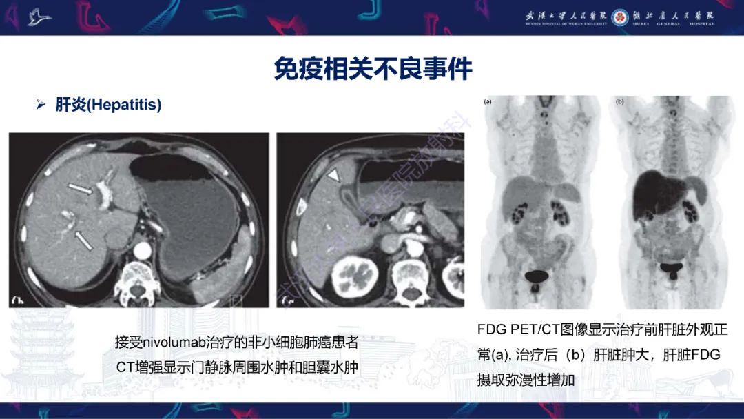 影像PPT - 【PPT】肿瘤免疫治疗疗效及不良事件影像评估-19