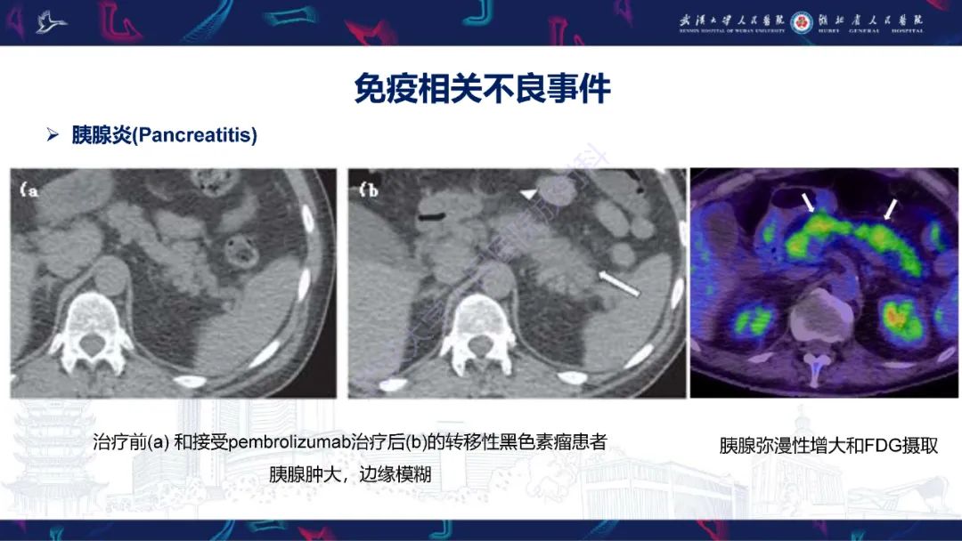 影像PPT - 【PPT】肿瘤免疫治疗疗效及不良事件影像评估-20