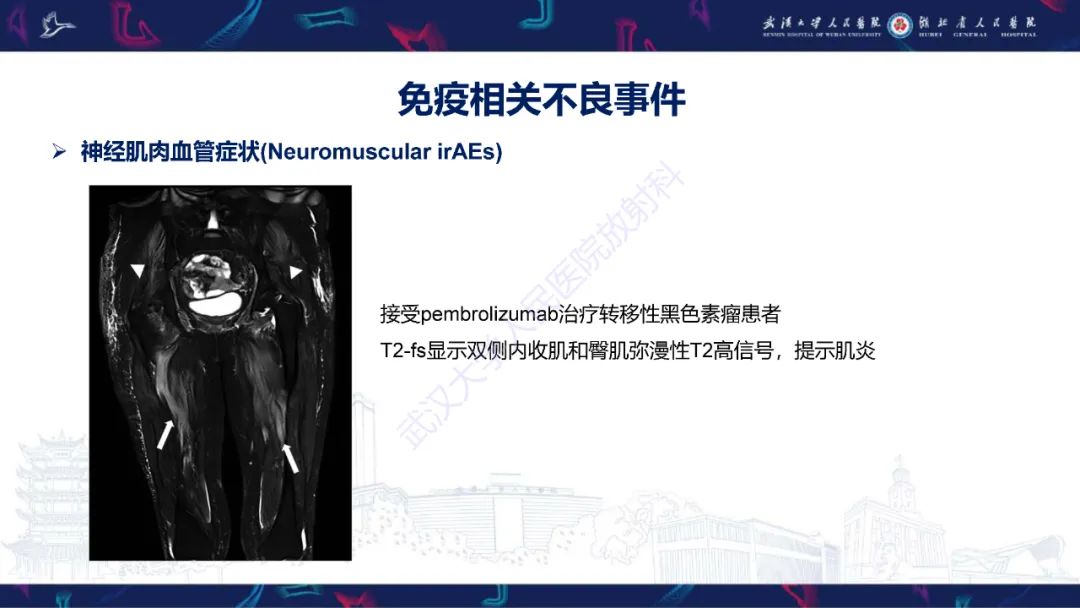 影像PPT - 【PPT】肿瘤免疫治疗疗效及不良事件影像评估-22