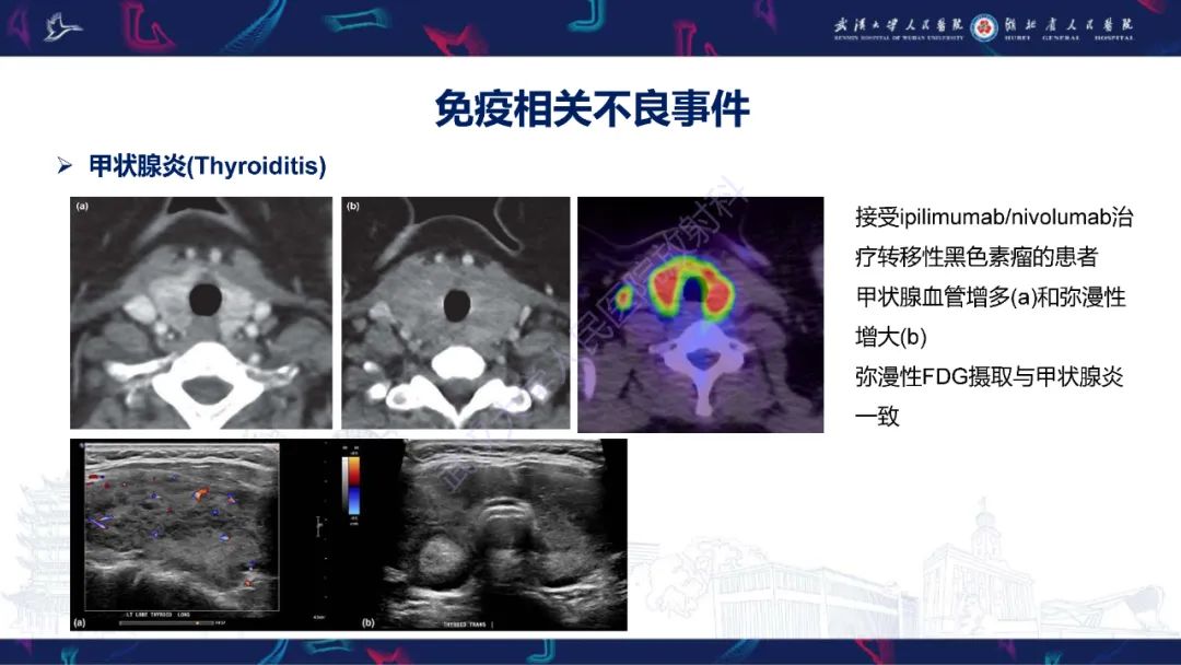 影像PPT - 【PPT】肿瘤免疫治疗疗效及不良事件影像评估-23