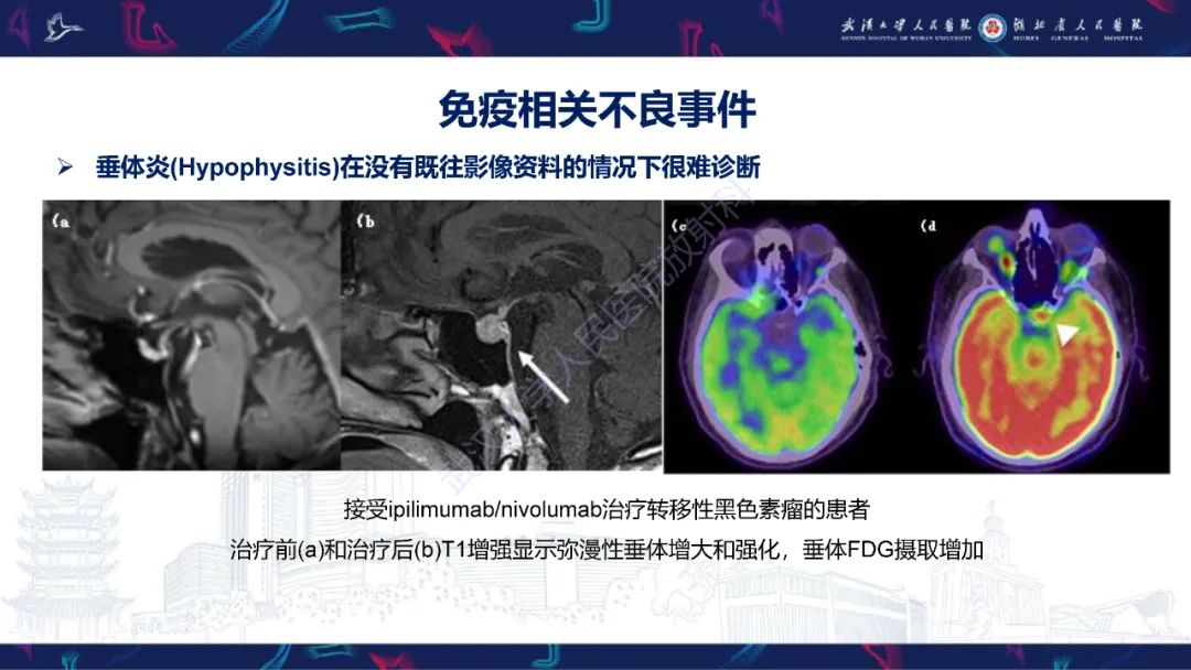 影像PPT - 【PPT】肿瘤免疫治疗疗效及不良事件影像评估-24