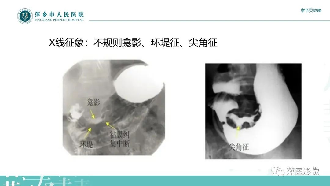 影像PPT - 【PPT】胃癌影像表现及鉴别诊断-13