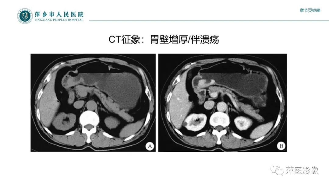 影像PPT - 【PPT】胃癌影像表现及鉴别诊断-15