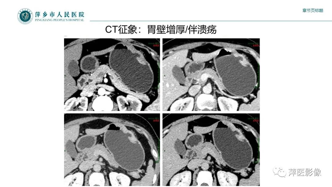 影像PPT - 【PPT】胃癌影像表现及鉴别诊断-16