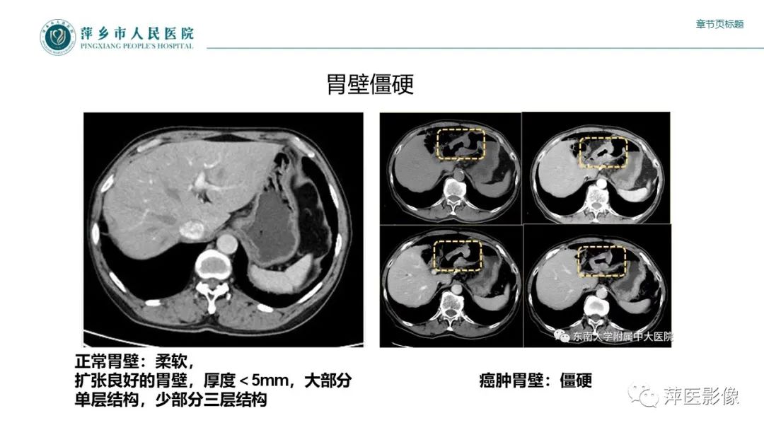 影像PPT - 【PPT】胃癌影像表现及鉴别诊断-17