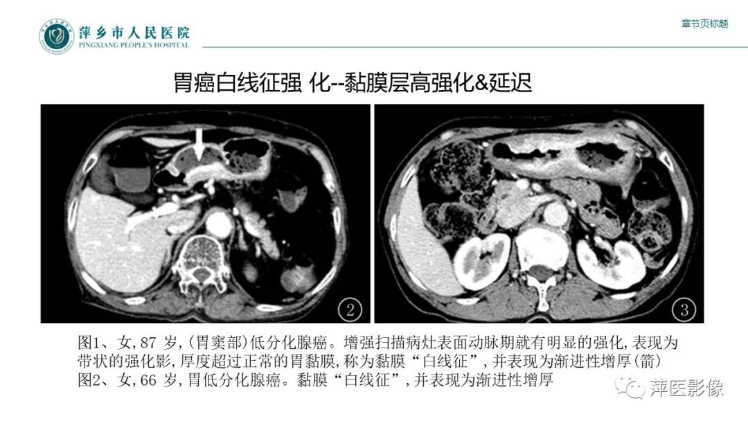 影像PPT - 【PPT】胃癌影像表现及鉴别诊断-18