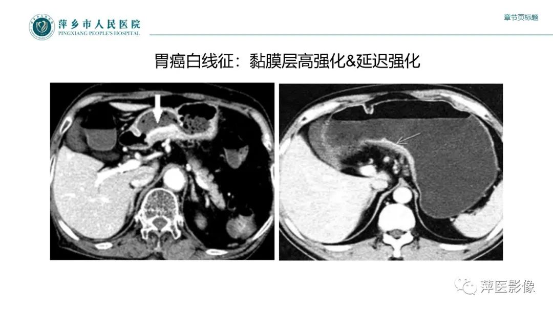 影像PPT - 【PPT】胃癌影像表现及鉴别诊断-19