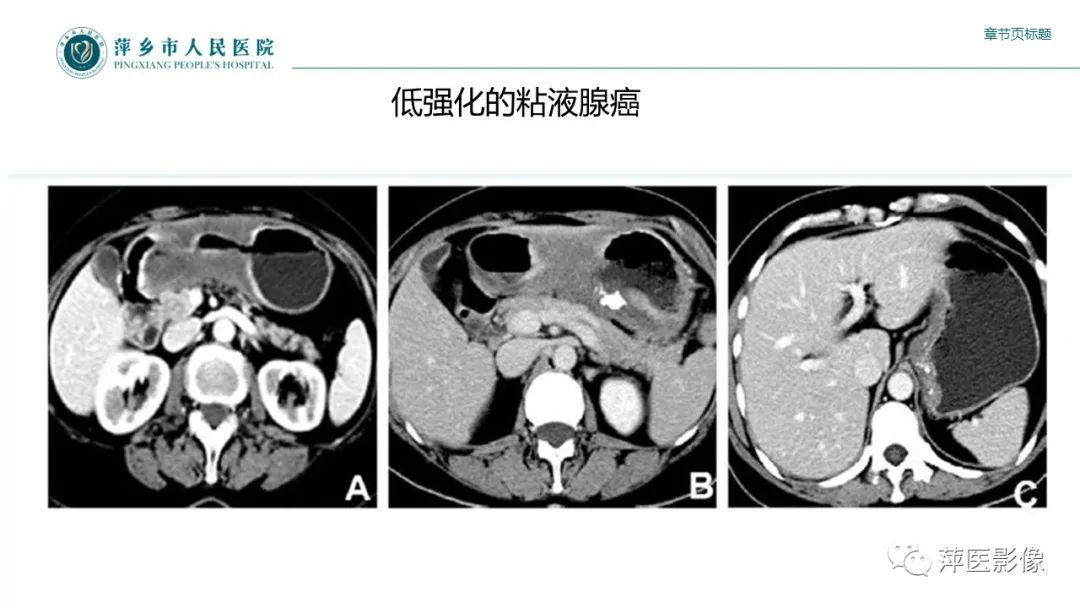 影像PPT - 【PPT】胃癌影像表现及鉴别诊断-21
