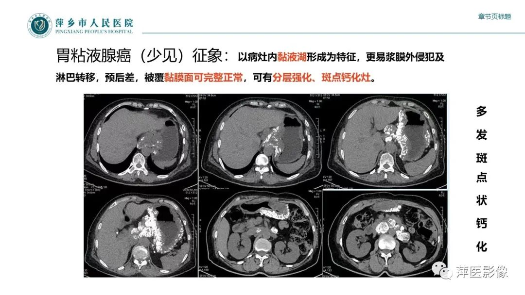 影像PPT - 【PPT】胃癌影像表现及鉴别诊断-20
