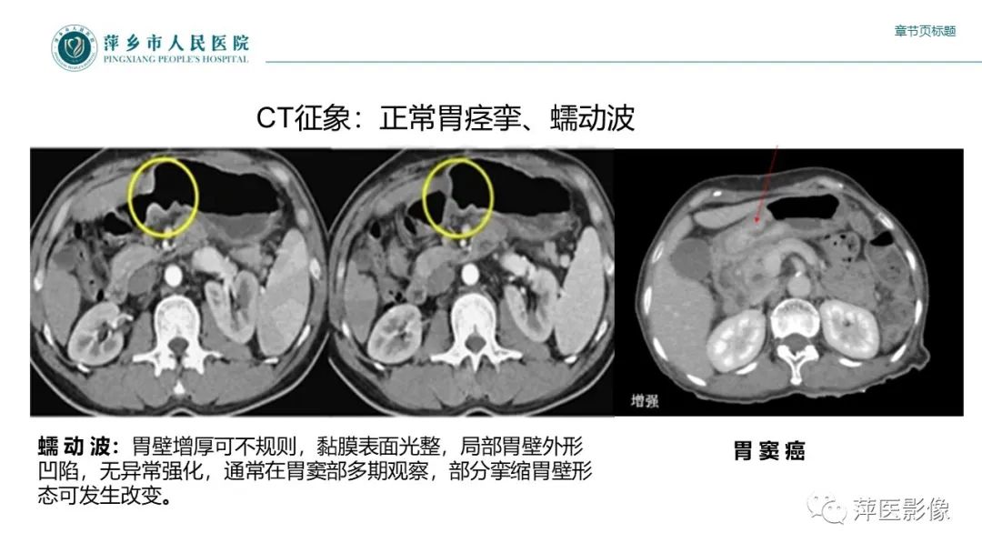影像PPT - 【PPT】胃癌影像表现及鉴别诊断-14