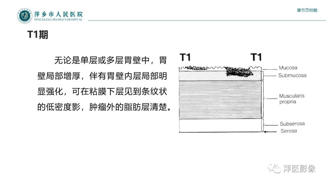 影像PPT - 【PPT】胃癌影像表现及鉴别诊断-24