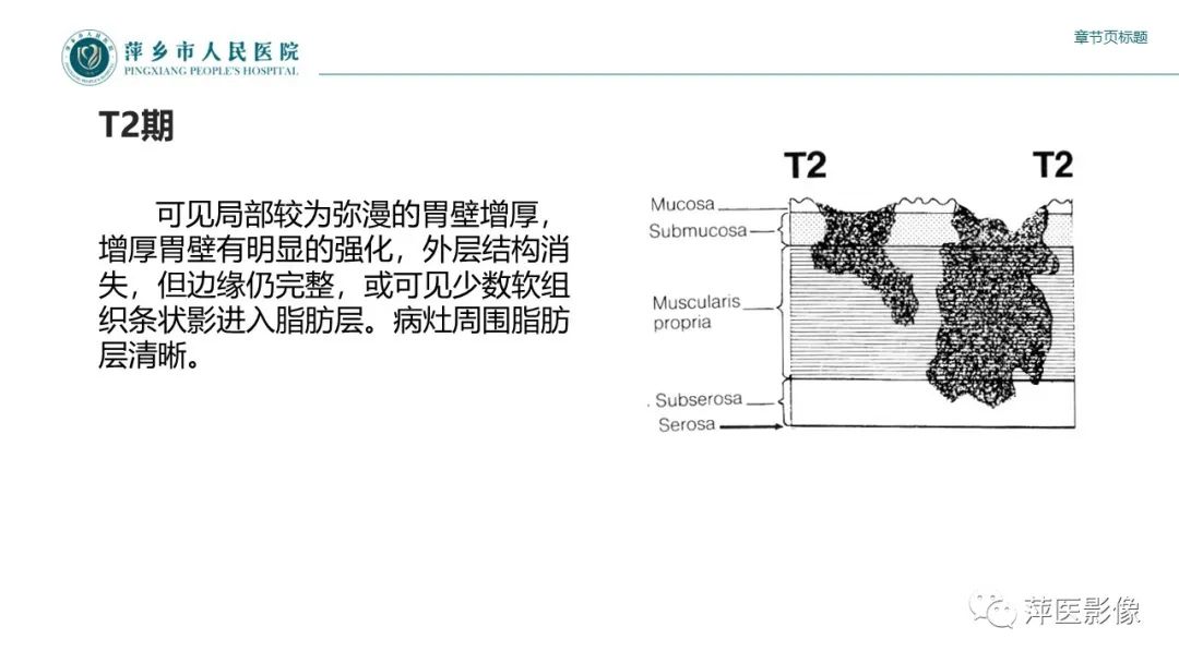 影像PPT - 【PPT】胃癌影像表现及鉴别诊断-26