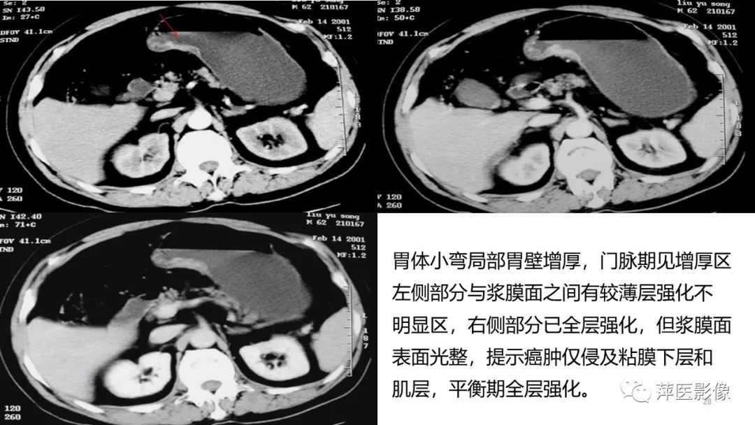 影像PPT - 【PPT】胃癌影像表现及鉴别诊断-27
