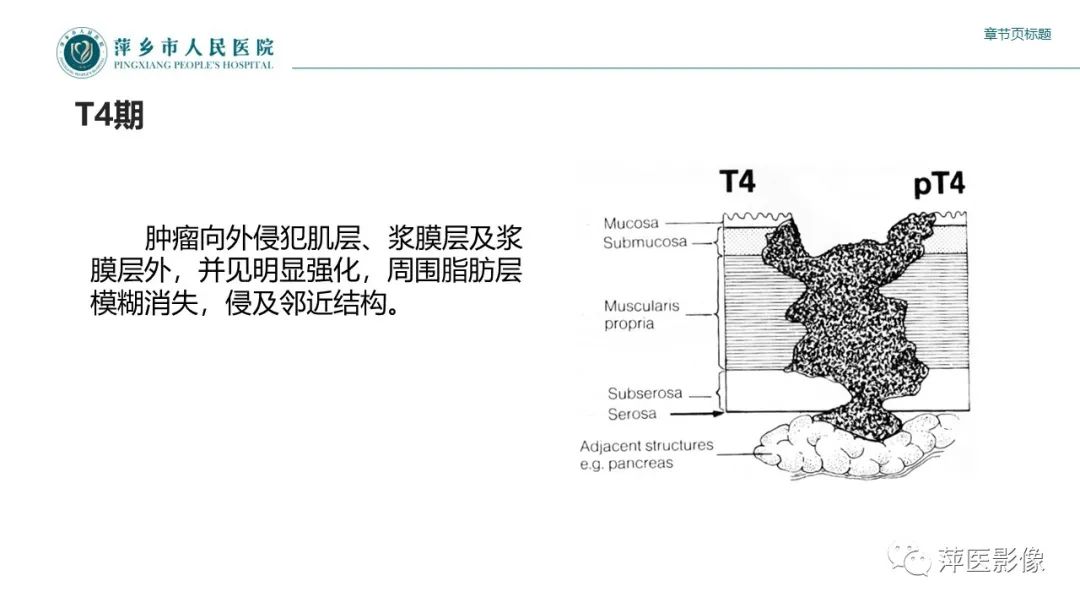 影像PPT - 【PPT】胃癌影像表现及鉴别诊断-30