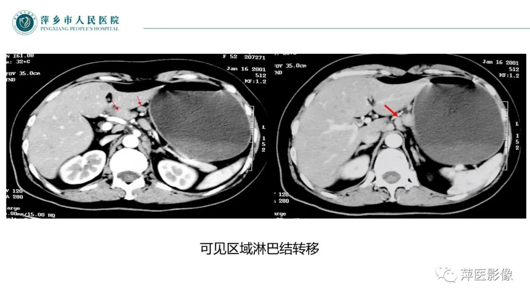 影像PPT - 【PPT】胃癌影像表现及鉴别诊断-32