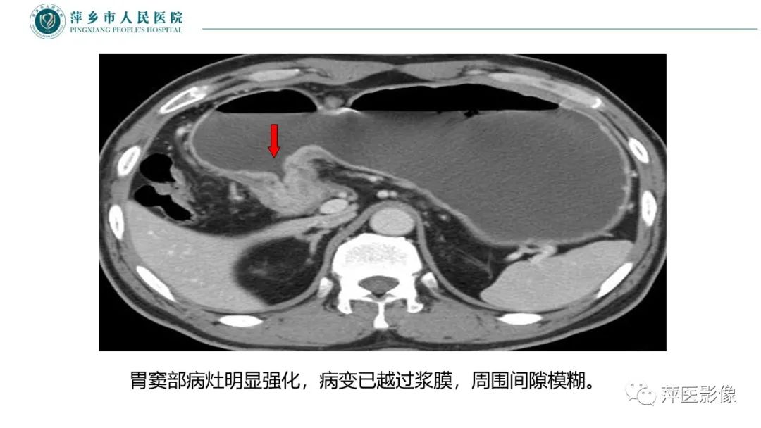 影像PPT - 【PPT】胃癌影像表现及鉴别诊断-31