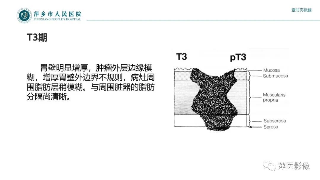 影像PPT - 【PPT】胃癌影像表现及鉴别诊断-28