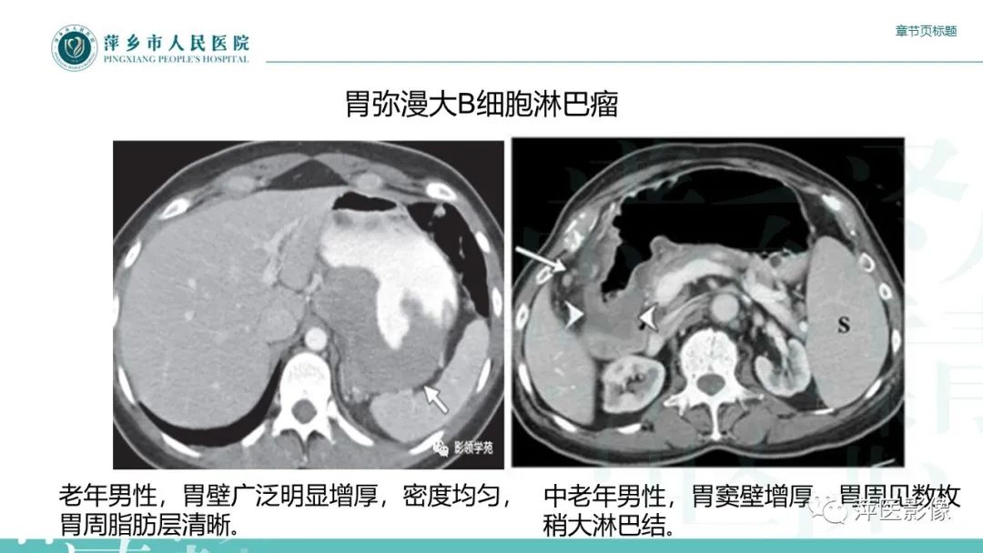 影像PPT - 【PPT】胃癌影像表现及鉴别诊断-38