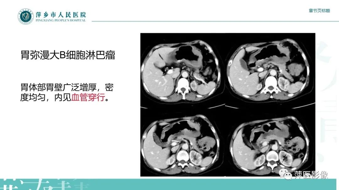 影像PPT - 【PPT】胃癌影像表现及鉴别诊断-39