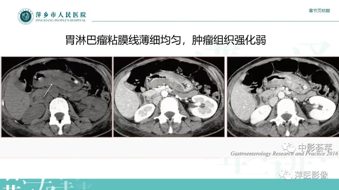 影像PPT - 【PPT】胃癌影像表现及鉴别诊断-40