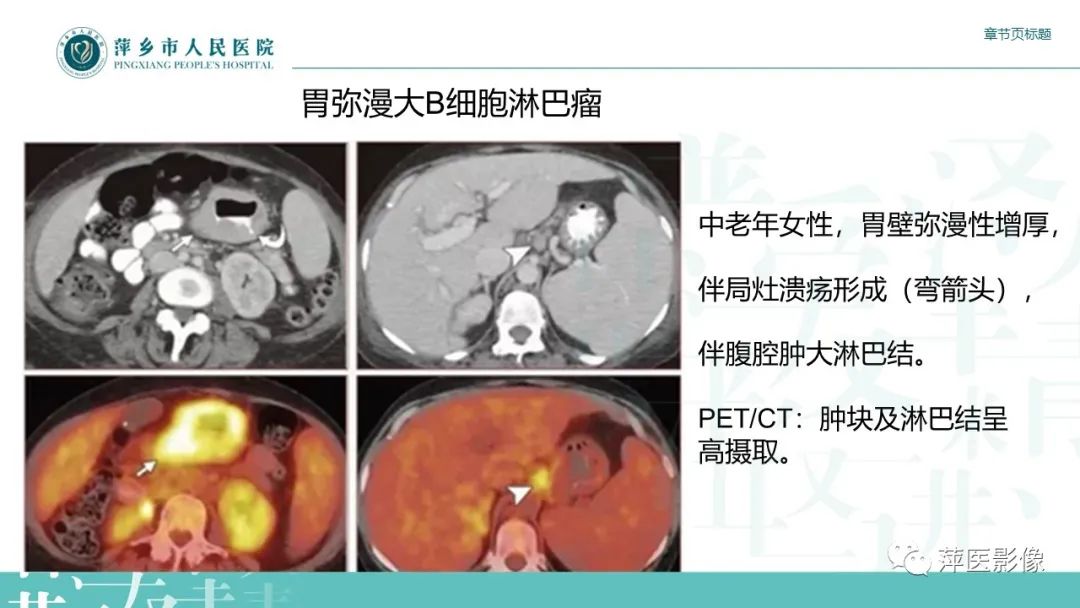 影像PPT - 【PPT】胃癌影像表现及鉴别诊断-41
