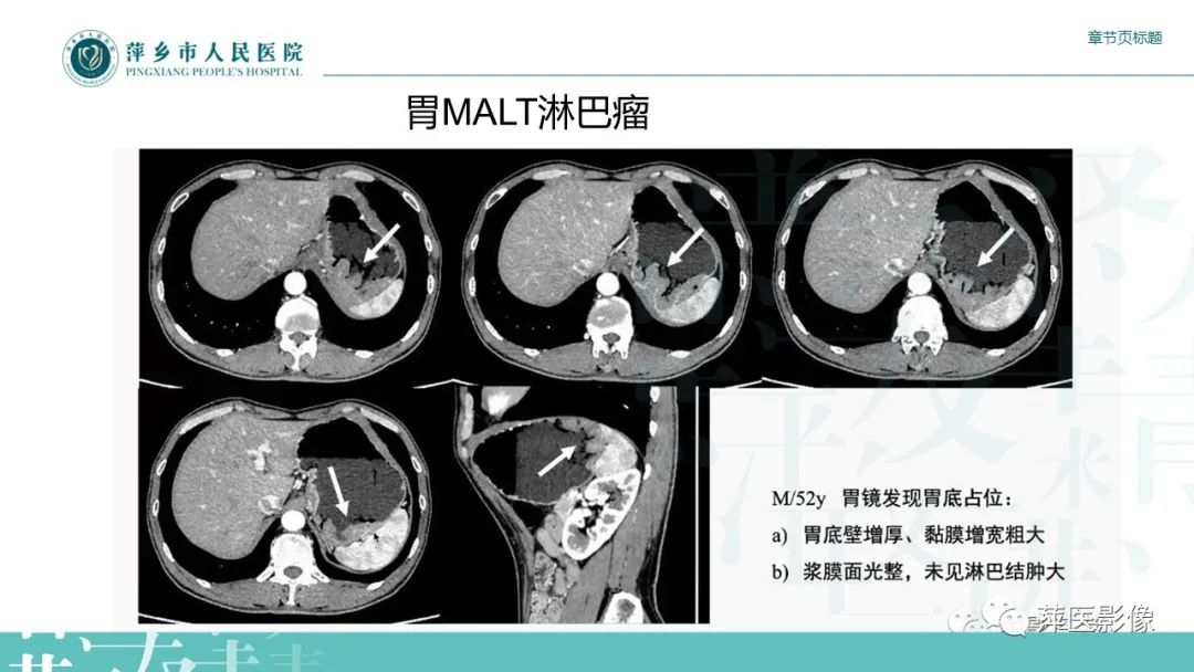 影像PPT - 【PPT】胃癌影像表现及鉴别诊断-43