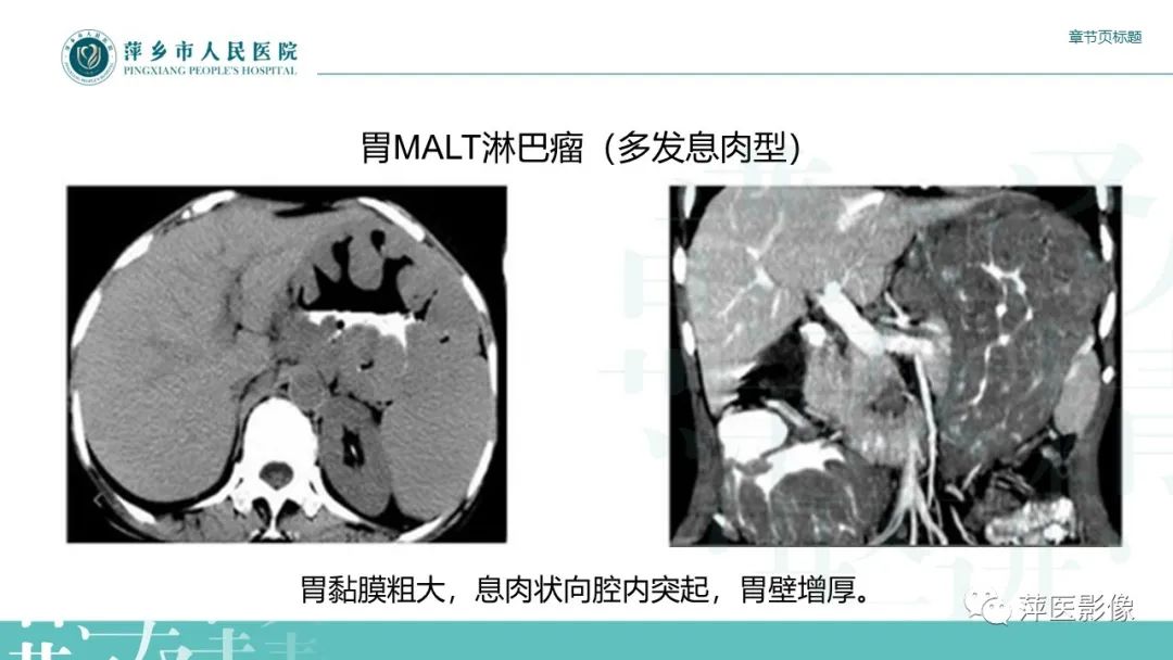 影像PPT - 【PPT】胃癌影像表现及鉴别诊断-45