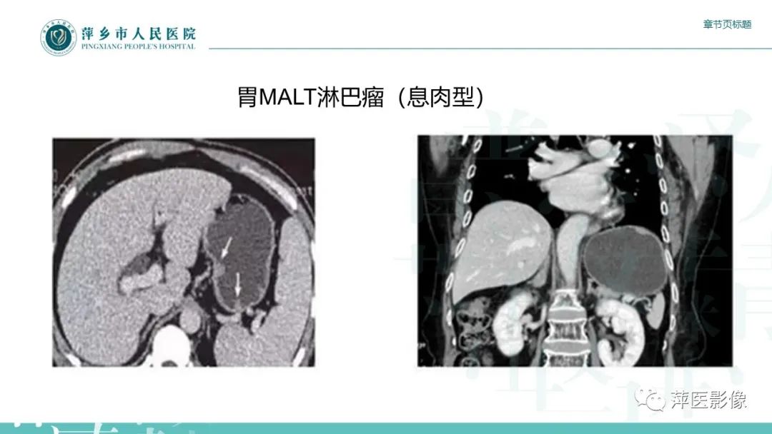 影像PPT - 【PPT】胃癌影像表现及鉴别诊断-44
