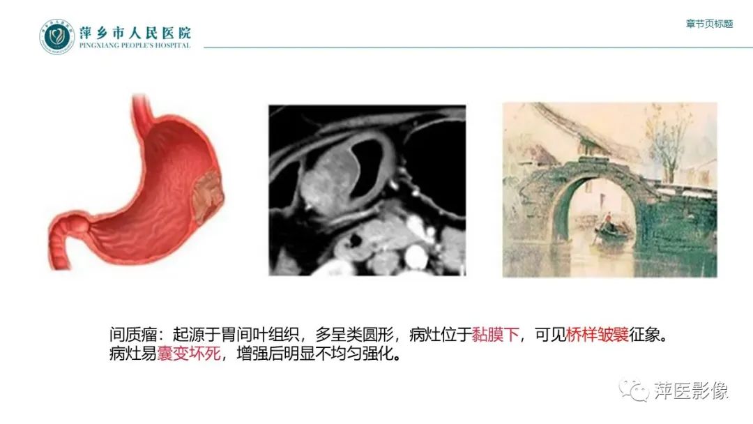 影像PPT - 【PPT】胃癌影像表现及鉴别诊断-50
