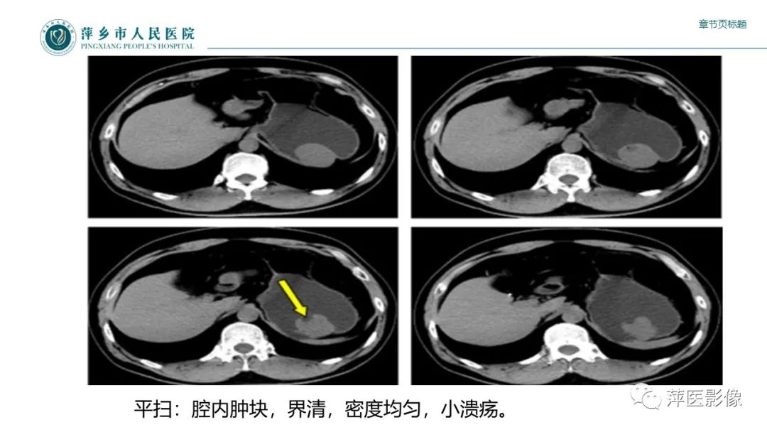 影像PPT - 【PPT】胃癌影像表现及鉴别诊断-51