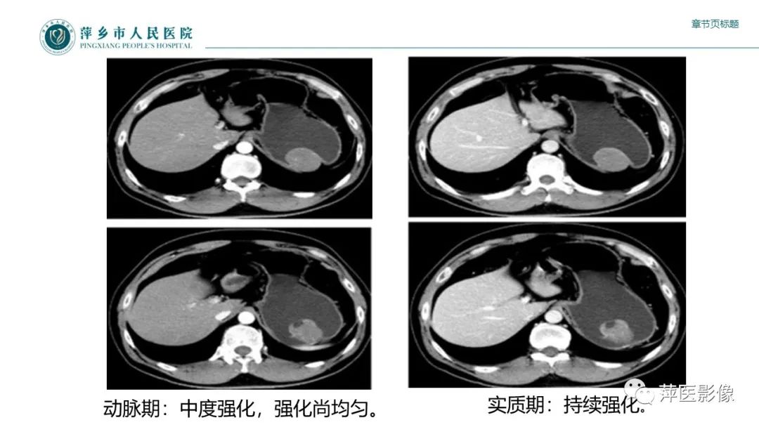 影像PPT - 【PPT】胃癌影像表现及鉴别诊断-52