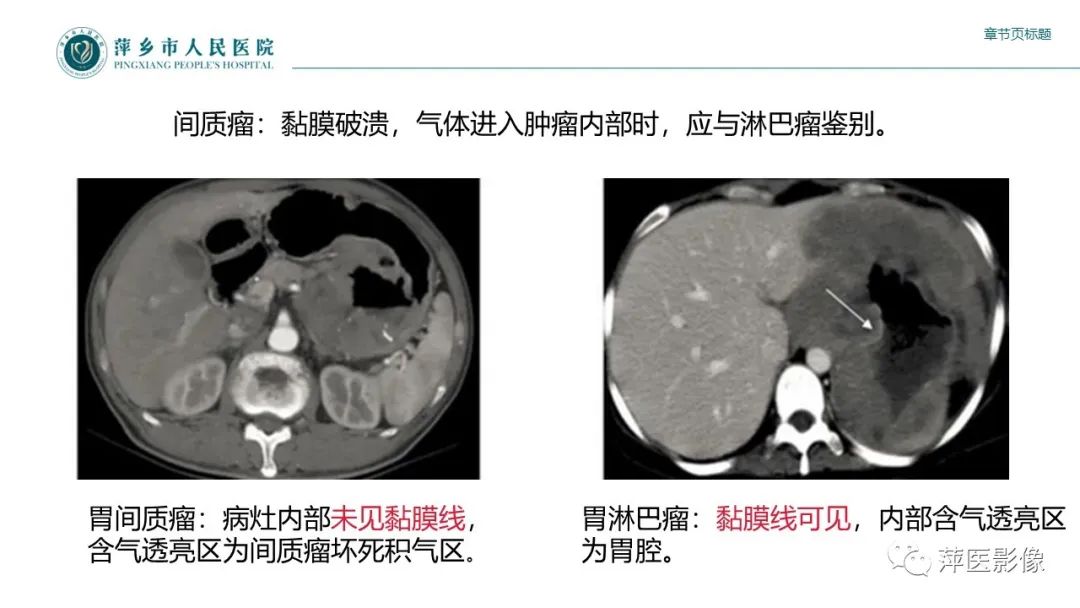 影像PPT - 【PPT】胃癌影像表现及鉴别诊断-53